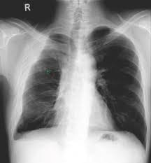 oracentesis of loculated pleural eﬀusions is facilitated by ultrasound. Clinical Vignette 27 Miphidic