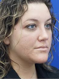 Dorsal Convexity De-Hump 4268