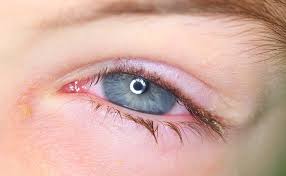 Patienten mit trockenen augen haben viele fragen. Blepharitis Was Tun Bei Einer Lidrandentzundung Brille24