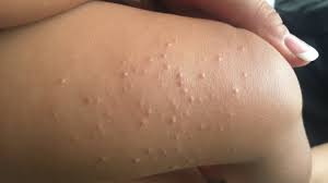 Learn molluscum contagiosum causes (virus), rash symptoms, home remedy, and treatment facts. Molluscum Contagiosum Most Common Toddlers Kids Skin Condition