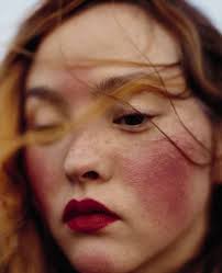 Rosacea can't be cured