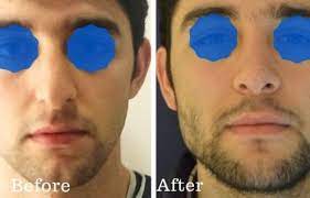 Istanbul aesthetics plastic surgery center is a turkish clinic specialized in aesthetic, plastic and dental procedures, hair transplant, and brazilian butt . Istanbul Aesthetics Center Medical Tourism With Mediglobus The Best Treatment Around The World