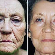 Beautifulskinbyjane Beautifulskinbyjane Instagram Photos And Videos Microneedling Natural Face Lift Skin Needling