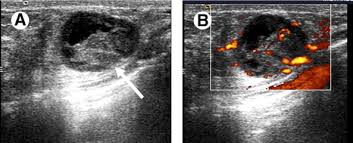 Diffuse mastopathy is visualized in the form of ultrasound of the breast during pregnancy is mandatory for women who have previously been treated for breast cancer. Staging Of Breast Cancer With Ultrasound Sciencedirect