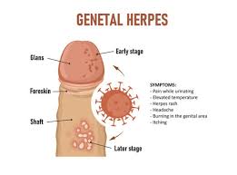 Image result for genital herpes