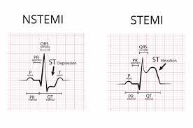 Apr 30, 2015 · nstemi is a type of heart attack. Was Ist Ein Nstemi Infarkt