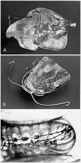 W10 digital activation program 1.4.1 portable by ratiborus. Initial Effects Of Treatment Of Class Ii Malocclusion With The Herren Activator Activator Headgear Combination And Jasper Jumper American Journal Of Orthodontics And Dentofacial Orthopedics