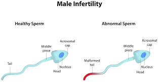 The Growing Problem Of Male Infertility