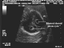 Ultrasound Of Choroid Plexus Cysts