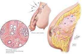 Image result for Mastalgia