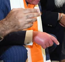 swollen 'sausage' fingers ...