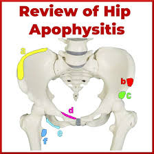 Image result for Pubic Apophysitis