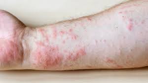 Image result for allergy rash on the legs
