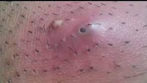 This is termed as an ingrown hair, as the name suggests, the hair that has grown inwards, back into the skin. House Of Zeenel Ingrown Pubic Hair Cyst Can Really Be Facebook