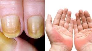Faktor keturunan juga menjadi penyebab kuku kuning yang sering terjadinya. Jika Terlihat Tanda Ini Di Tangan Waspadalah Bisa Jadi Ciri Ciri Gejala Gejala Penyakit Liver Halaman All Tribun Jambi