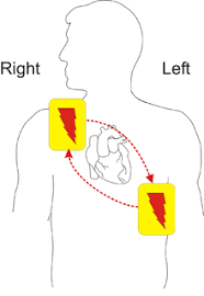 The automated external defibrillator (aed) is a device capable of automatically detecting a heart rhythm. Defibrillation Wikipedia