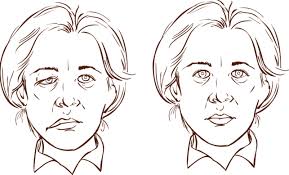A double blind gantz bj, rubinstein jt, gidley p, woodworth gg. Bell S Palsy Or Facial Paralysis Bell S Palsy Or Facial Paralysis