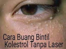 Seperti halnya lemak, kolesterol tidak larut dalam makanan memiliki sedikit pengaruh pada kadar kolesterol. Bahaya Biji Kolestrol Sekitar Mata