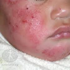 Image result for ekzema face
