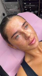 Stunning Tear Trough Filler Transformation for Ruby Dale