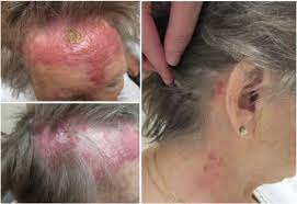 A sore that continually crusts over but doesn&#x27;t heal. Diffuse Recurrent Cutaneous Melanoma Of The Scalp And Neck Successfully Treated With Volumetric Modulated Arc Therapy And Concurrent Ipilimumab Practical Radiation Oncology
