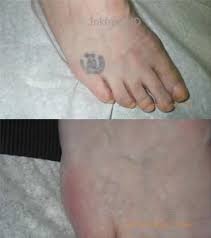 Here it is, another laser tattoo removal machine for you. Does Laser Tattoo Removal Leave A Scar Inkfree Md