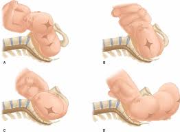 Image result for Manual Rotation in Occipitoposterior Presentation