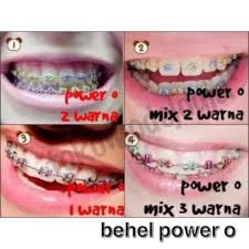Selamat datang di di website kami, kami menjual alat alat behel dengan harga yang murah dengan kwalitas yang bagus, kami menjual seperti lem behel orthoforce, lem behel light cure, lem behel gc fuji ortho, sonde, kawat niti, bracket behel, laser behel (led curing), bucaltube, wax (pencegah sariawan). Behel Gigi Lepas Pasang Asli Original Sepasang Atas Bawah Double O Power O Kitty Mickey Bunga Chain Shopee Indonesia