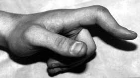 Image result for Elson Extensor Tendon Test