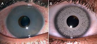 Since 2002, we are working hard to build solutions for our clients. Complications Of Cosmetic Artificial Iris Implantation And Post Explantation Outcomes American Journal Of Ophthalmology