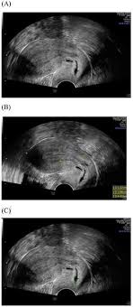 During the exam you will feel a light amount of . Updated Applications Of Ultrasound In Uterine Cervical Cancer