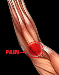 Medial epicondylitis is a type of tendinitis, a condition marked by inflammation or irritation of a tendon. Medial Epicondylitis Golfer S Elbow Pro Tec Athletics