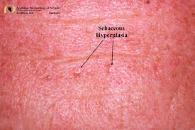 Image result for Sebaceous Hyperplasia