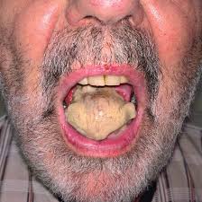 Image result for Jaw Claudication