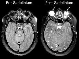 Gadolinium is a moderately ductile, moderately hard, silvery white metal that is fairly stable in air. Gadolinium Lawsuits Gadolinium Settlements Consumer Alert Now