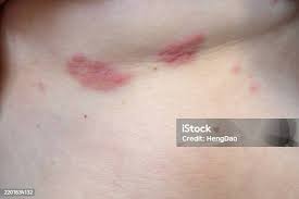 Image result for zoster under breasts