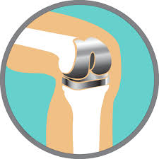 Proteza de sold cand alte terapii de indepartare a durerii provocata de distrugerea soldului esueaza, inlocuirea articulatiei ar putea fi raspunsul. Tipurile De Proteze De Sold NecimentatÄƒ CimentatÄƒ CeramicÄƒ