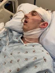 Epstein Barr Encephalitis