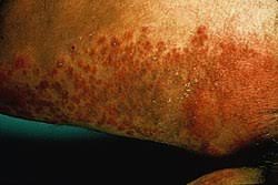 Image result for penis mycosis symptoms