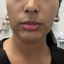 Filler or Botox for marionette lines/ DAO muscle? (Photo)