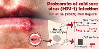 It usually causes cold sores, also known as orolabial herpes, on or near the mouth. Proteomics Of Cold Sore Virus Hsv 1 Infection Department Of Pathology