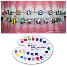 Black And Light Blue Braces 3m Alastik Braces Colours Braces Colors Purple And Black Dental Braces