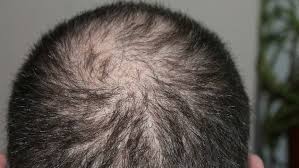 This was confirmed earlier this year with the. Hair Loss Why Does It Happen And Can It Be Stopped Abc News