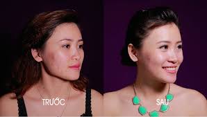 Tôi Đã Lấy Lại Tự Tin Thế Nào Khi Trị Mụn Và Vết Thâm Bằng Laser? | Emmie  by HappySkin