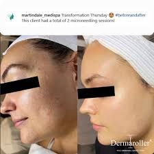 People often ask us how many micro-needling sessions it takes to see  results. The answer is one. These results were just posted by one of our  great clinics in Calgary, showing the