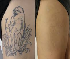 No one has more before and after pictures from real laser tattoo removal clients! Need Tattoo Removal Permanent Makeup Collagen Induction And More Convenient To Hollywood Fl Cal Natural Tattoo Removal Tattoo Removal Cost Tattoo Removal