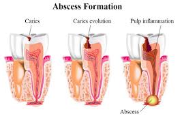 What Is Phoenix Dental Abscess News Tooth Cavity Abscess Tooth Tooth Decay