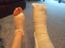 A person may require a surgical boot after bunion removal surgery. Before During After Bunion Surgery Bunion Surgery And Hardware Removal Second Foot First Week First Checkup