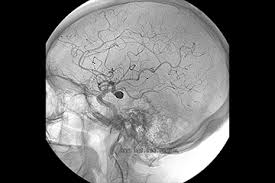 Most people with brain aneurysms have no symptoms. The Other Stroke How Brain Aneurysms Affect Stroke Risk Brain Ut Southwestern Medical Center