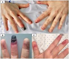 The injury to a cell is said to be irreversible if it kills the cell. An Unusual Case Of Distal Necrosis Looking For The Truth European Journal Of Internal Medicine